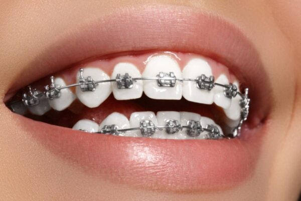 Giải pháp niềng răng đối với răng thưa