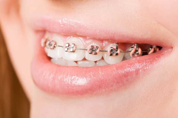 Quá trình niềng răng có ảnh hưởng đến sức khỏe không?