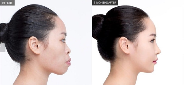 Sự thay đổi sau trước và sau khi niềng răng