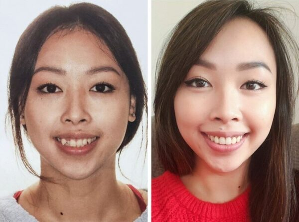 Sự thay đổi khuôn mặt sau khi niềng răng