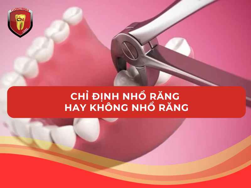 Khi nào cần nhổ và khi nào không cần nhổ răng ?