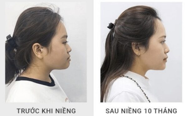 Hình ảnh góc nghiêng trước và sau khi niềng răng