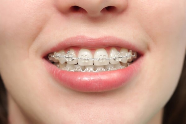 Các trường hợp nuốt niềng răng vào bụng thường gặp