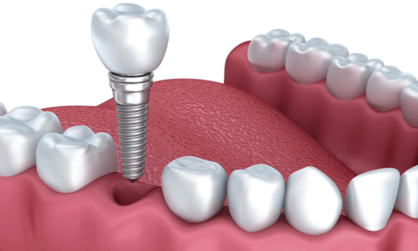 Vậy nên trồng răng implant trước hay niềng răng trước?