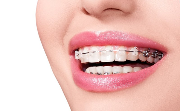 Quy trình niềng răng sau khi trồng răng implant