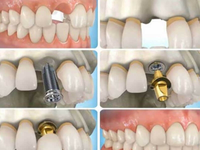 Phương pháp trồng răng Implant