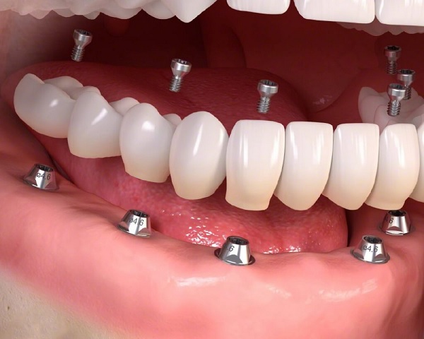 Phương pháp trồng răng implant Hàn Quốc có tốt không?