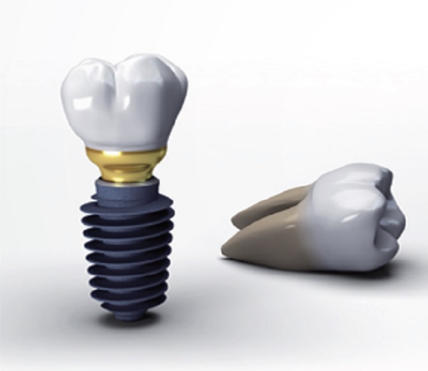 Trồng răng implant Hàn Quốc có tốt không khi dùng Implant Megagen
