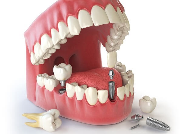 Trồng răng implant Hàn Quốc có tốt không khi dùng Implant Dentium