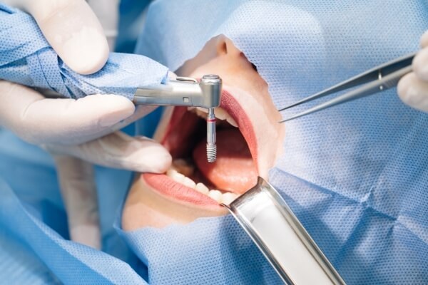 Trồng răng implant Hàn Quốc có tốt không và mức giá trồng là bao nhiêu
