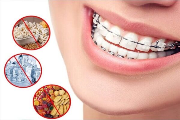 Hạn chế ăn đồ cứng khi niềng răng 