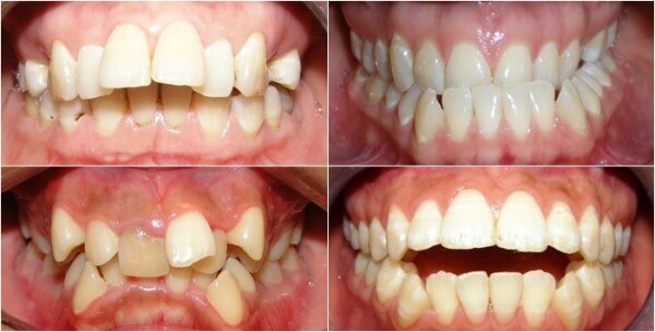 Tổng hợp các cách khắc phục tình trạng lệch nhân trung sau niềng răng