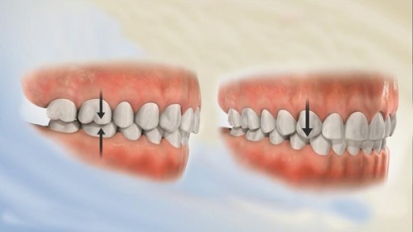 Niềng răng có thể hỗ trợ điều trị cho việc lệch nhân trung từ trước