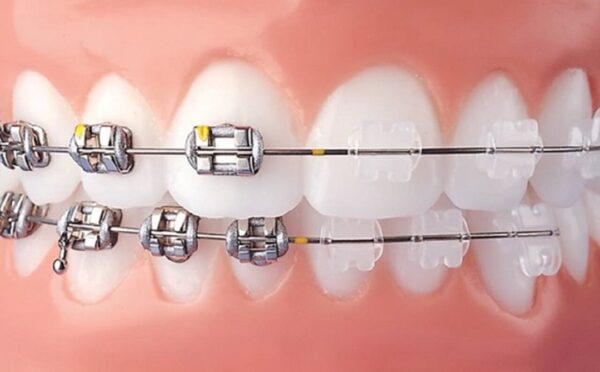 Niềng răng ở nha khoa không uy tín có thể dùng khí cụ kim loại vượt mức cho phép