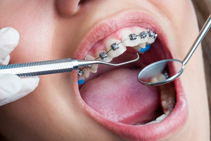Sử dụng kỹ thuật niềng răng không phù hợp