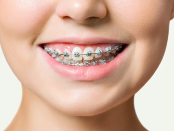 Niềng răng hỏng: Dấu hiệu và cách khắc phục