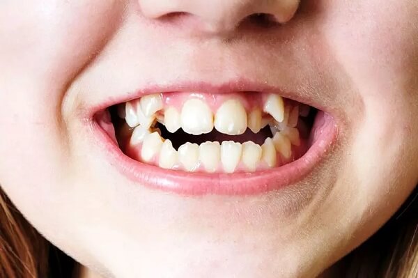 Niềng răng khểnh 2 bên có hiệu quả không?