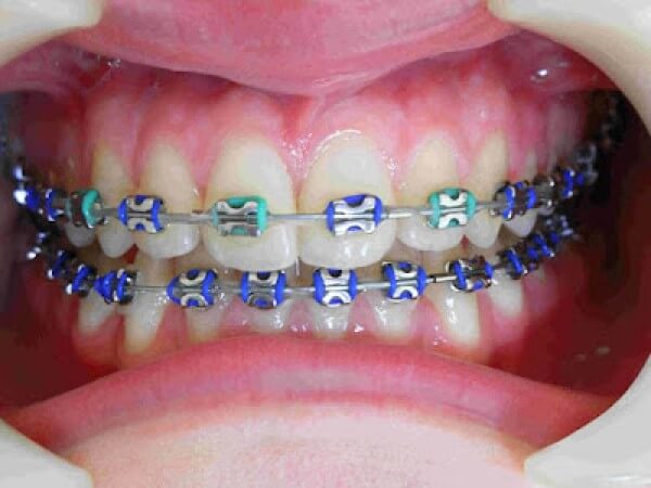 Quy trình niềng 2 răng khểnh tại Nha Khoa Cường Nhân