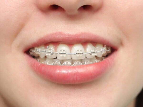 Niềng răng xong bị móm: Nguyên nhân và cách khắc phục hiệu quả