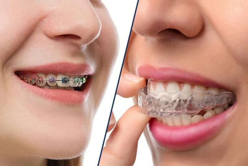 Có thể xảy ra tình trạng hô lại nếu không cẩn thận trong việc chăm sóc răng sau niềng