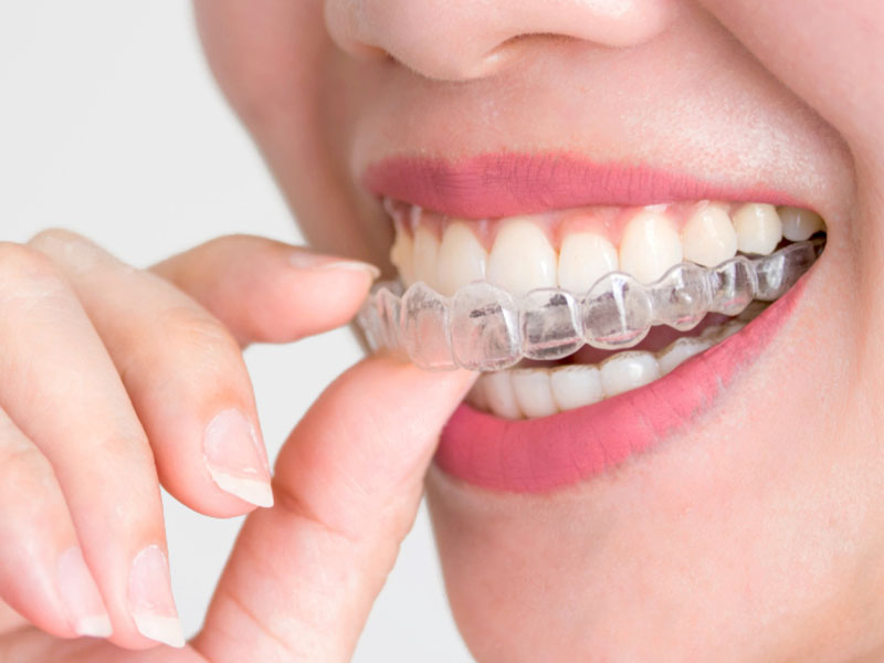 Cần chăm sóc răng và lựa chọn đơn vị niềng răng uy tín ngay từ đầu để tránh tình trạng răng hô sau niềng