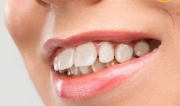 Các nguyên nhân khiến cho răng bị lung lay trong khi niềng