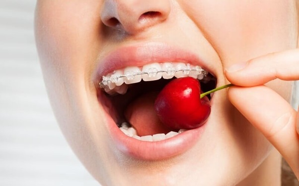Chế độ dinh dưỡng với người niềng răng cực kỳ quan trọng, hãy đảm bảo trong công đoạn siết và quá trình niềng bạn không mắc phải các sai lầm