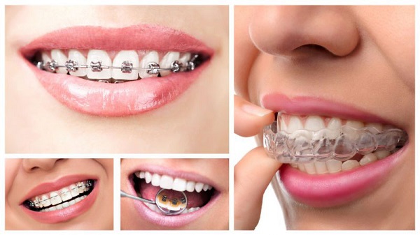 Phương pháp niềng răng có cải thiện mặt lệch được không?