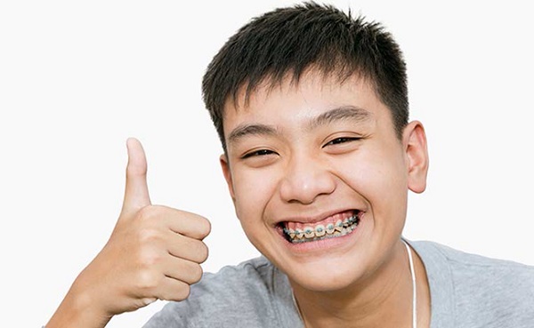 Phương pháp giải quyết tình trạng niềng răng bị lệch mặt
