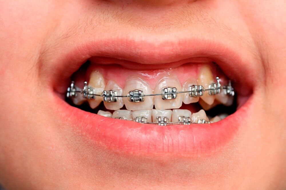 Niềng răng bị lòi chân răng khiến nụ cười kém duyên đi rất nhiều  