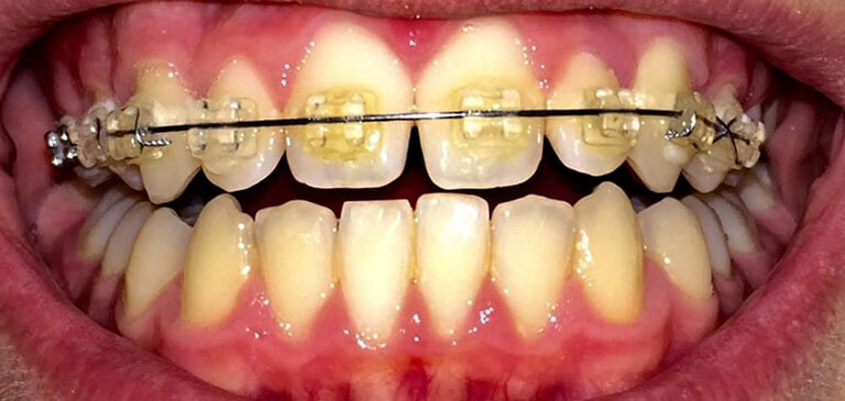 Chăm sóc răng miệng chưa đúng cách cũng là nguyên nhân gây lòi chân răng