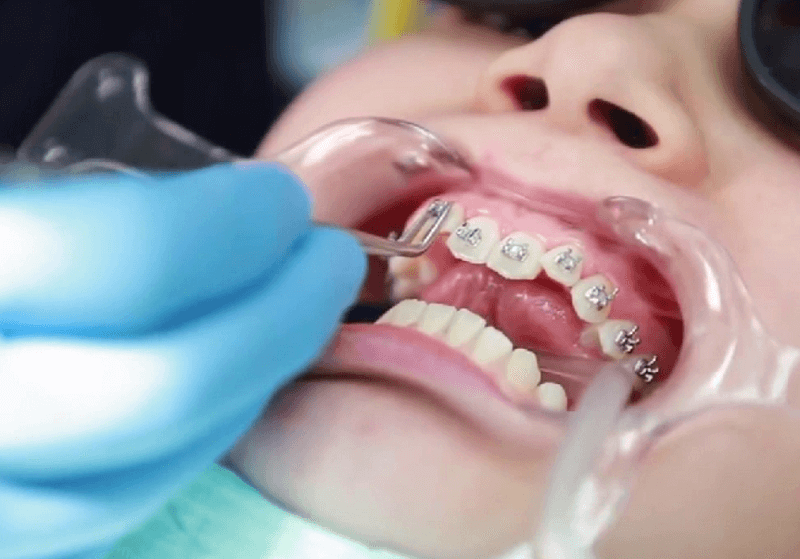 Niềng răng sai kỹ thuật gây lòi chân răng 