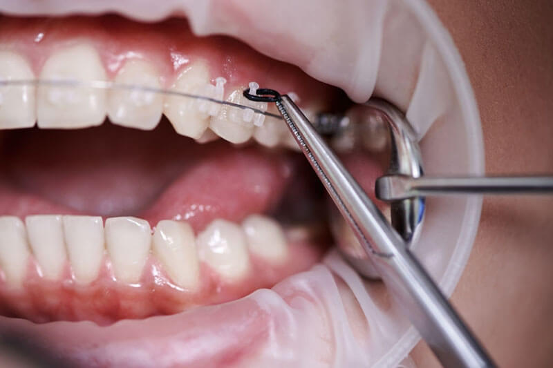 Niềng răng bị lộ chân răng sẽ dẫn đến nhiều bệnh lý răng miệng khác 