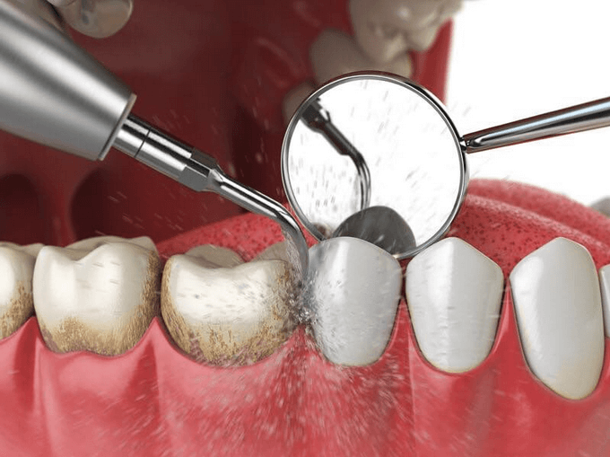Bạn cần chăm sóc răng miệng đúng cách và cạo vôi răng định kỳ