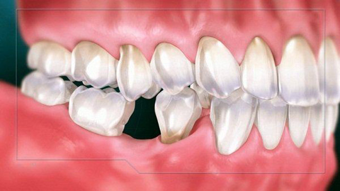 Tiêu xương là bệnh lý thường xảy ra khi bạn mất răng 