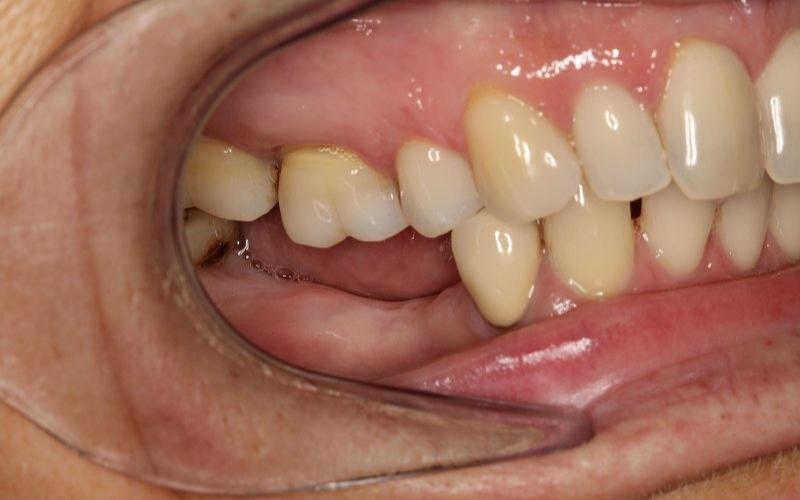 Tiêu xương hàm khi niềng răng gây ra nhiều bệnh lý về răng miệng 