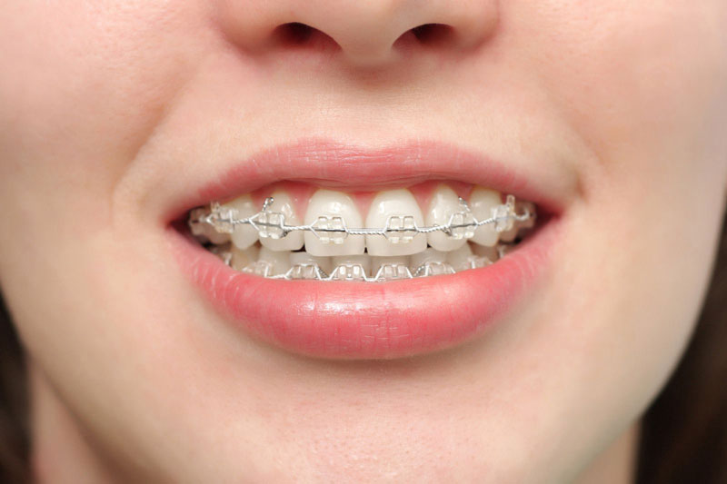 Cần lựa chọn đơn vị uy tín để thực hiện niềng răng và trị tiêu xương hàm 