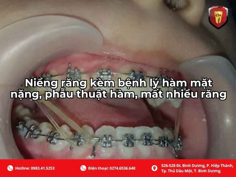 Niềng răng kèm bệnh lý về hàm mặt nặng - phẫu thuật hàm