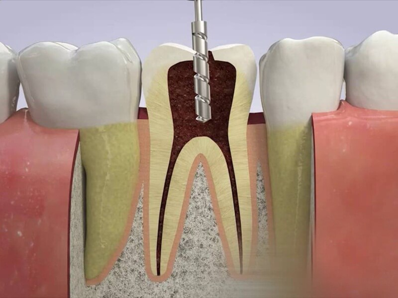 Niềng răng có thể không được khuyến nghị nếu răng chết tủy do viêm nhiễm hoặc nhiễm trùng nặng, cho đến khi tình trạng được kiểm soát và điều trị thành công.