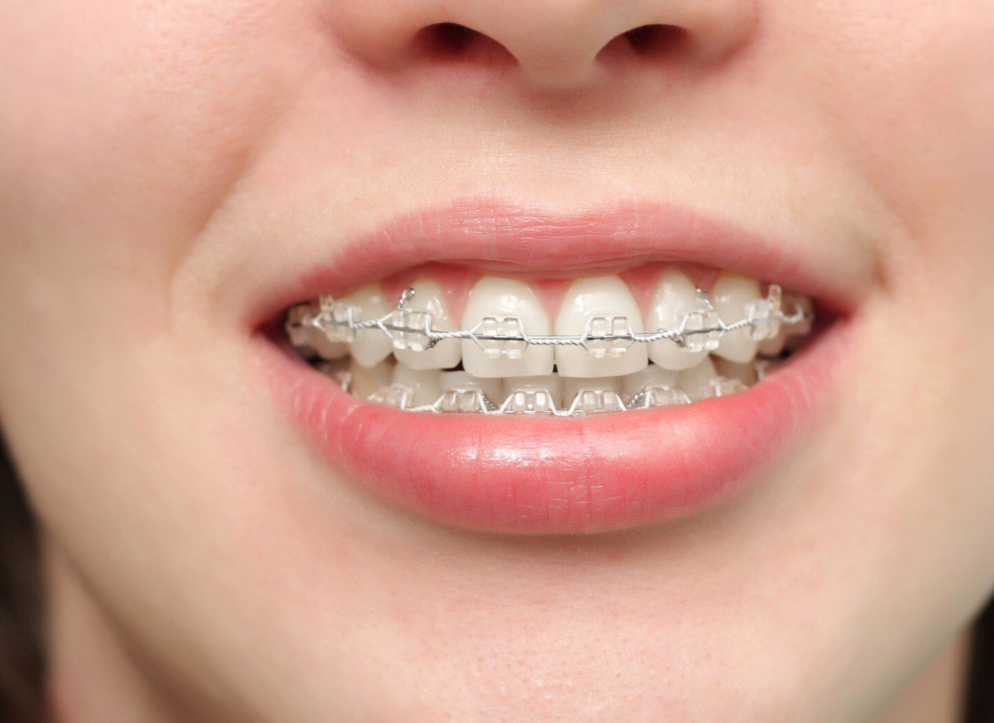 Răng đã lấy tủy có niềng được không là một câu hỏi mà nhiều bạn quan tâm