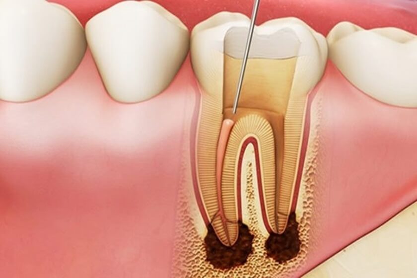 Răng chết tủy có rất nhiều nguyên nhân như sâu răng, tiến trình lão hóa, răng nứt, gãy,..