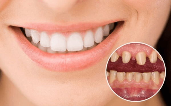 Có nên làm răng sứ không phụ thuộc vào cấu trúc và tình trạng răng cụ thể