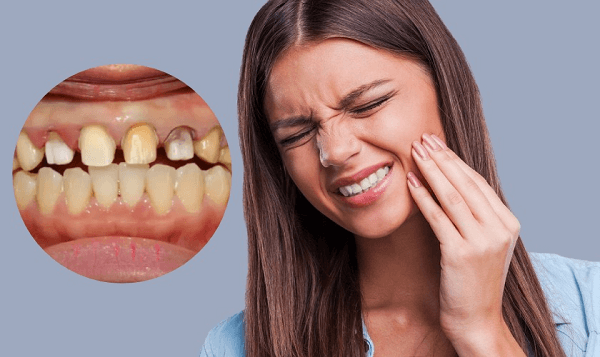 Cảnh báo những hậu quả bọc răng sứ kém chất lượng
