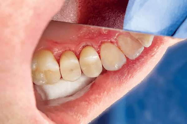 Nguy cơ viêm lợi, nướu răng