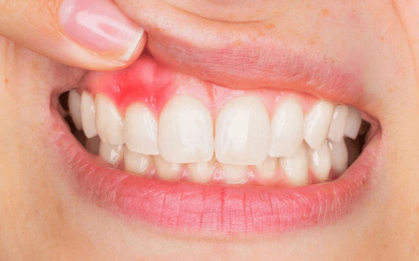 Viêm tủy răng gây nguy hiểm là hậu quả bọc răng sứ kém chất lượng
