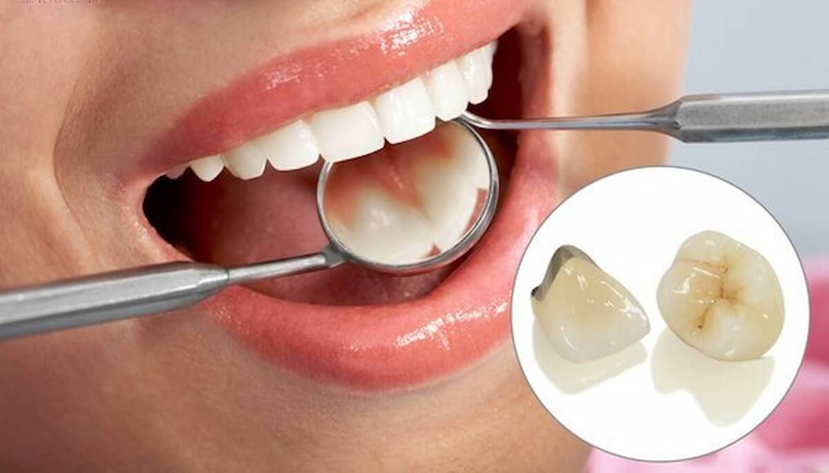 Việc làm răng sứ có đau không thì tùy thuộc vào nhiều yếu tố trong quá trình điều trị