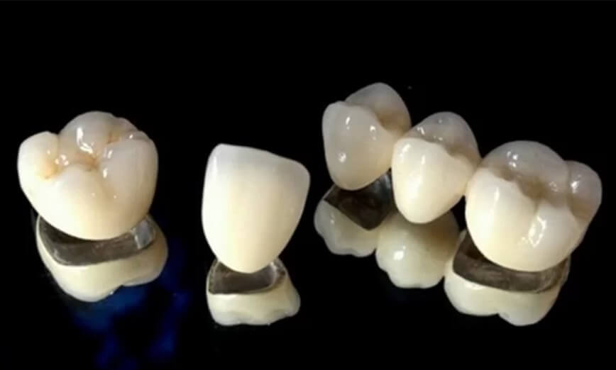 Việc trồng răng sứ ít nhiều sẽ gây đau nhức cùng khó chịu cho người làm răng