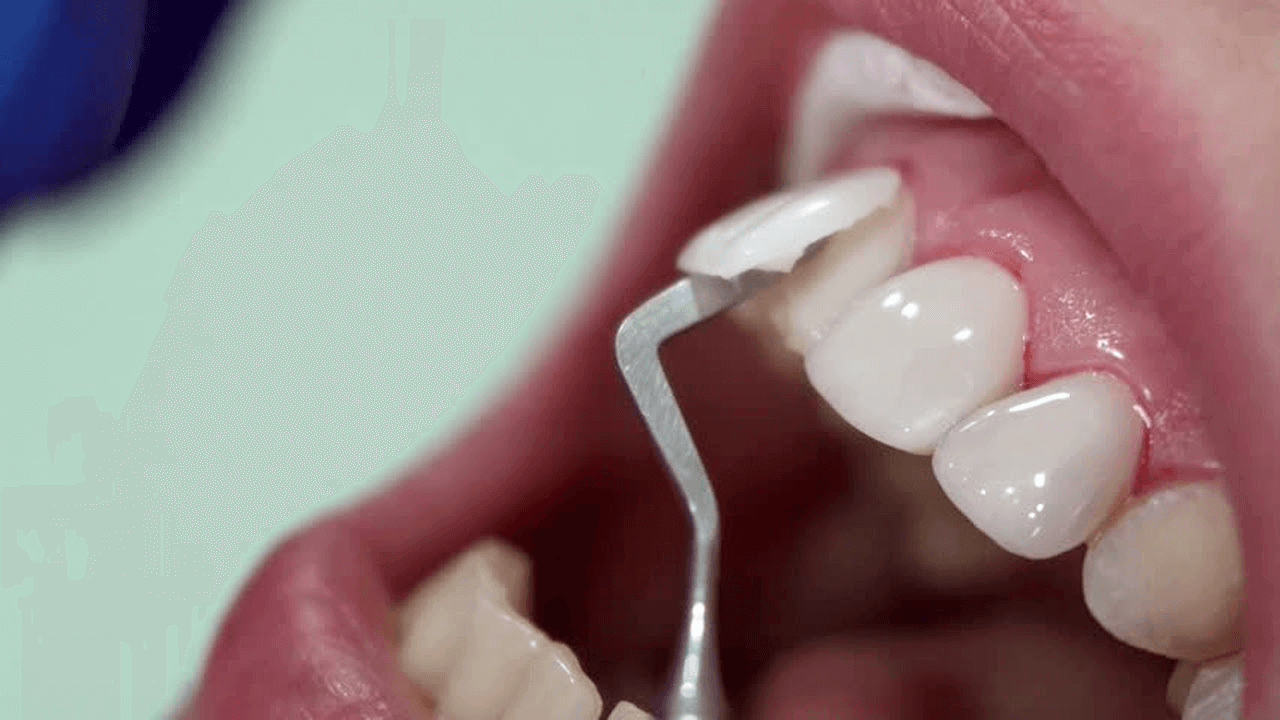 Bọc răng sứ gặp biến chứng, thay mới răng sứ hoặc răng sứ tới tuổi thọ,.. đây là các trường hợp cần bọc lại răng sứ