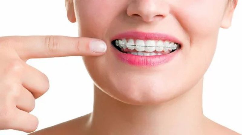 Niềng răng giúp điều chỉnh răng về đúng vị trí 