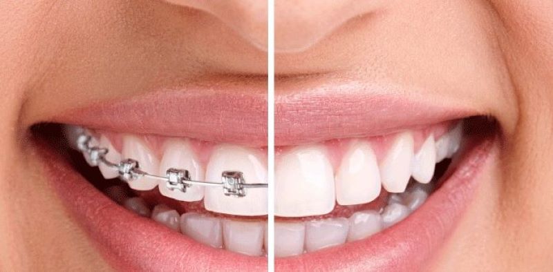 Nếu chất lượng răng tốt bạn vẫn có thể niềng răng sau khi bọc sứ